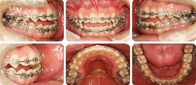 種植釘多維運(yùn)用矯正高角反頜及開頜—對(duì)羅晨醫(yī)生專訪及病例展示(上) 種植釘多維運(yùn)用矯正高角反頜及開頜—對(duì)羅晨醫(yī)生專訪及病例展示(上)