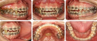 種植釘多維運(yùn)用矯正高角反頜及開頜—對(duì)羅晨醫(yī)生專訪及病例展示(上) 種植釘多維運(yùn)用矯正高角反頜及開頜—對(duì)羅晨醫(yī)生專訪及病例展示(上)