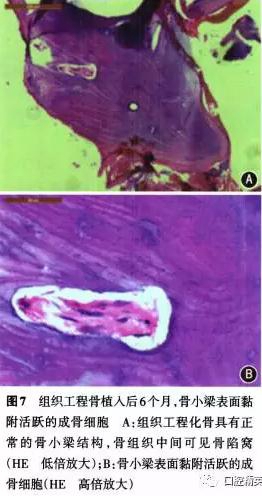 組織工程骨修復(fù)上頜骨缺損及牙種植一例 組織工程骨修復(fù)上頜骨缺損及牙種植一例