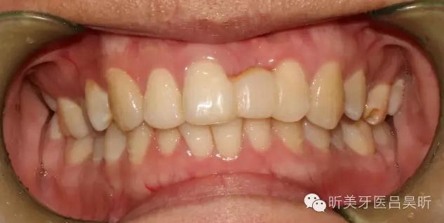 種植失敗的骨增量處理一例 種植失敗的骨增量處理一例