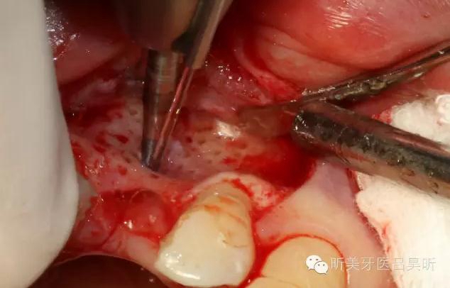 種植失敗的骨增量處理一例 種植失敗的骨增量處理一例