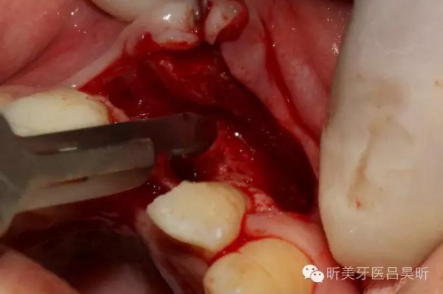 種植失敗的骨增量處理一例 種植失敗的骨增量處理一例