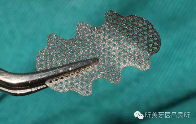 種植失敗的骨增量處理一例 種植失敗的骨增量處理一例