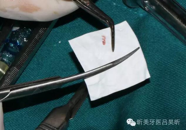 種植失敗的骨增量處理一例 種植失敗的骨增量處理一例