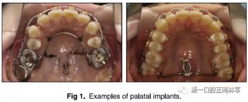 正畸文獻閱讀--上頜支抗初次植入失敗后二次植入穩(wěn)定性的研究 正畸文獻閱讀--上頜支抗初次植入失敗后二次植入穩(wěn)定性的研究