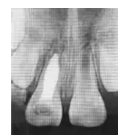 【病例分享】年輕恒牙伴牙根內(nèi)吸收根尖誘導成形術一例