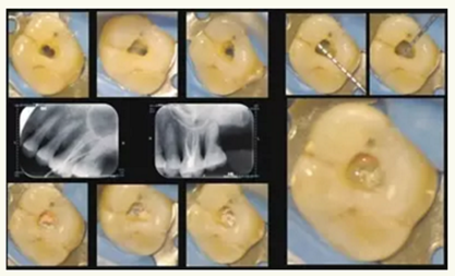 顯微知著 從齒開始&mdash;&mdash;上海第九人民醫(yī)院牙體牙髓科