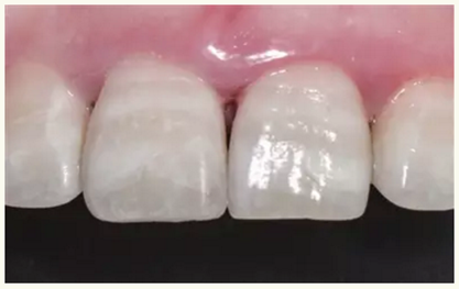 顯微知著 從齒開始&mdash;&mdash;上海第九人民醫(yī)院牙體牙髓科