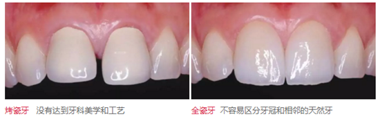 醫(yī)生，我的烤瓷牙上有個黑線怎么回事？