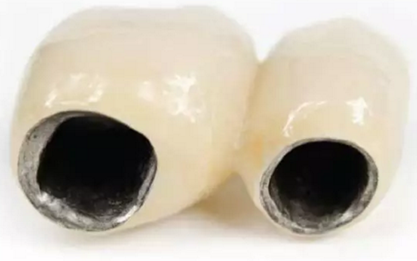 醫(yī)生，我的烤瓷牙上有個黑線怎么回事？