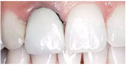 醫(yī)生，我的烤瓷牙上有個黑線怎么回事？