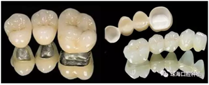 固定假牙(烤瓷牙)的致命缺點 固定假牙(烤瓷牙)的致命缺點