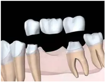 固定假牙(烤瓷牙)的致命缺點 固定假牙(烤瓷牙)的致命缺點