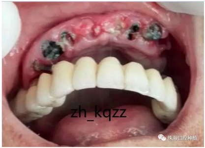 固定假牙(烤瓷牙)的致命缺點 固定假牙(烤瓷牙)的致命缺點