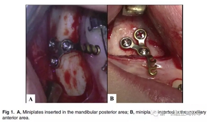 正畸矯正 正畸矯正