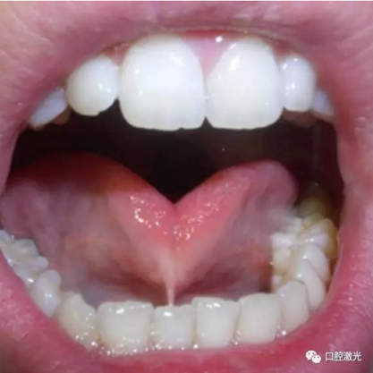 口腔激光在系帶延長(zhǎng)術(shù)中的應(yīng)用 口腔激光在系帶延長(zhǎng)術(shù)中的應(yīng)用