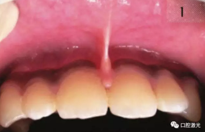 口腔激光在系帶延長(zhǎng)術(shù)中的應(yīng)用 口腔激光在系帶延長(zhǎng)術(shù)中的應(yīng)用
