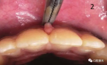 口腔激光在系帶延長(zhǎng)術(shù)中的應(yīng)用 口腔激光在系帶延長(zhǎng)術(shù)中的應(yīng)用