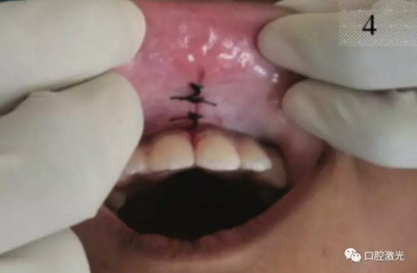 口腔激光在系帶延長(zhǎng)術(shù)中的應(yīng)用 口腔激光在系帶延長(zhǎng)術(shù)中的應(yīng)用