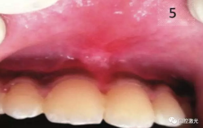 口腔激光在系帶延長(zhǎng)術(shù)中的應(yīng)用 口腔激光在系帶延長(zhǎng)術(shù)中的應(yīng)用