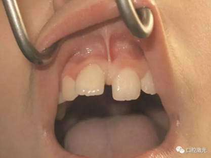 口腔激光在系帶延長(zhǎng)術(shù)中的應(yīng)用 口腔激光在系帶延長(zhǎng)術(shù)中的應(yīng)用
