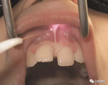 口腔激光在系帶延長(zhǎng)術(shù)中的應(yīng)用 口腔激光在系帶延長(zhǎng)術(shù)中的應(yīng)用