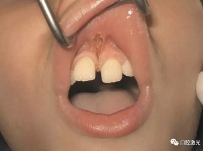 口腔激光在系帶延長(zhǎng)術(shù)中的應(yīng)用 口腔激光在系帶延長(zhǎng)術(shù)中的應(yīng)用