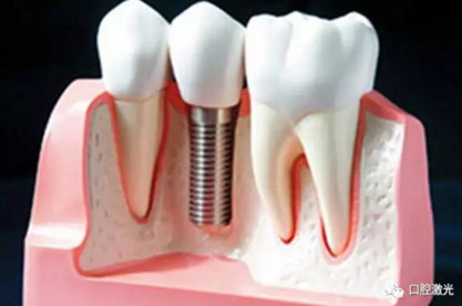 種植體周圍炎的激光療法 種植體周圍炎的激光療法