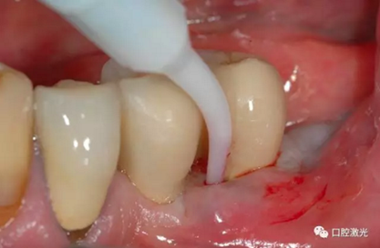 種植體周圍炎的激光療法 種植體周圍炎的激光療法