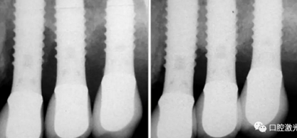種植體周圍炎的激光療法 種植體周圍炎的激光療法