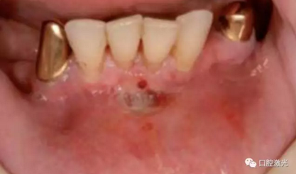 種植醫(yī)生如何用好口腔激光 種植醫(yī)生如何用好口腔激光