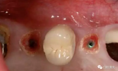 種植醫(yī)生如何用好口腔激光 種植醫(yī)生如何用好口腔激光