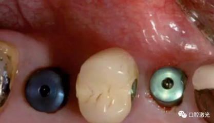 種植醫(yī)生如何用好口腔激光 種植醫(yī)生如何用好口腔激光