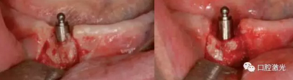 種植醫(yī)生如何用好口腔激光 種植醫(yī)生如何用好口腔激光