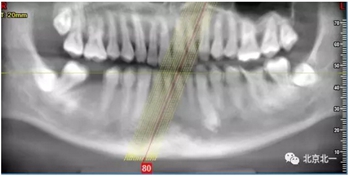 多學(xué)科病例分析---正畸、種植、微創(chuàng)拔牙多學(xué)科交叉病例