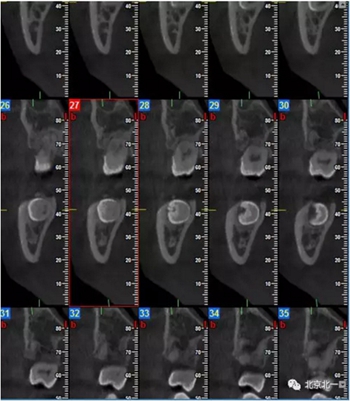 多學(xué)科病例分析---正畸、種植、微創(chuàng)拔牙多學(xué)科交叉病例