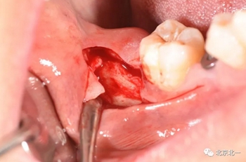 多學(xué)科病例分析---正畸、種植、微創(chuàng)拔牙多學(xué)科交叉病例