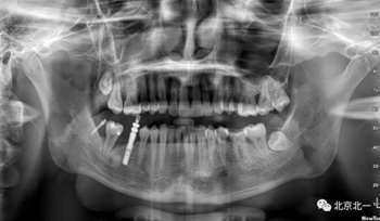 多學(xué)科病例分析---正畸、種植、微創(chuàng)拔牙多學(xué)科交叉病例
