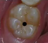 當(dāng)心&ldquo;腹黑&rdquo;齲齒，牙齒有個(gè)小洞也要補(bǔ)！