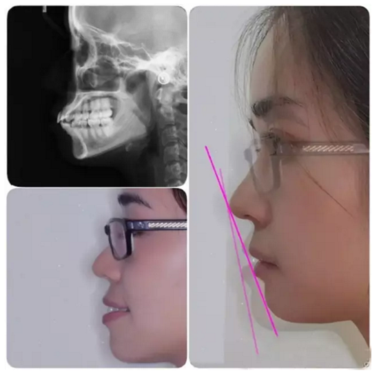 【口腔科普】關(guān)于矯牙前、中、后需要注意的問題，了解一下？