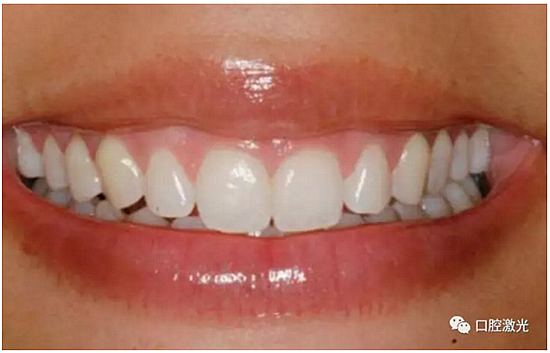 利用口腔激光增強瓷貼面最終美學(xué)效果 利用口腔激光增強瓷貼面最終美學(xué)效果