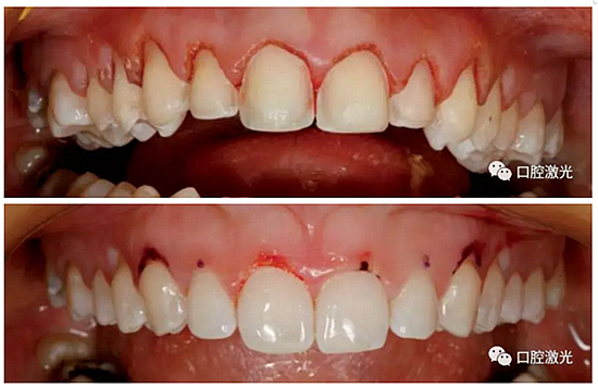 利用口腔激光增強瓷貼面最終美學(xué)效果 利用口腔激光增強瓷貼面最終美學(xué)效果