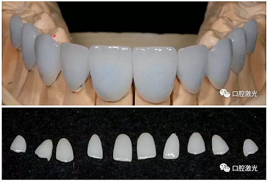 利用口腔激光增強瓷貼面最終美學(xué)效果 利用口腔激光增強瓷貼面最終美學(xué)效果
