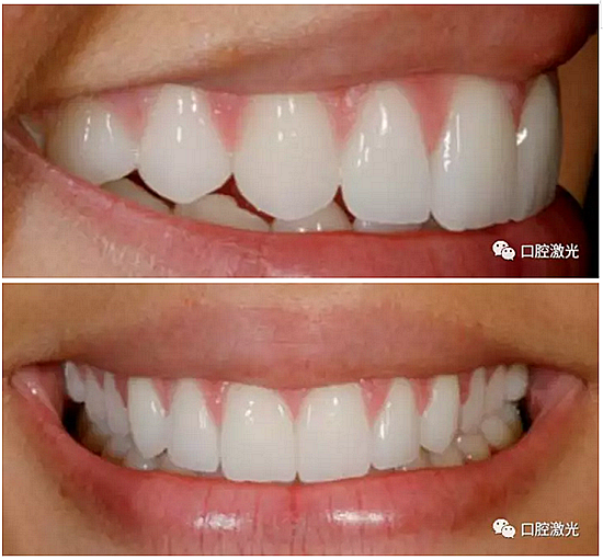 利用口腔激光增強瓷貼面最終美學(xué)效果 利用口腔激光增強瓷貼面最終美學(xué)效果