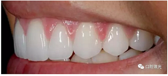 利用口腔激光增強瓷貼面最終美學(xué)效果 利用口腔激光增強瓷貼面最終美學(xué)效果