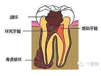 詳解牙疼的原因分幾種？