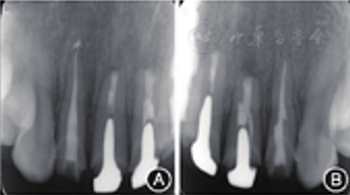 【病例討論】根管治療失敗患牙再治療一例(下) 【病例討論】根管治療失敗患牙再治療一例(下)