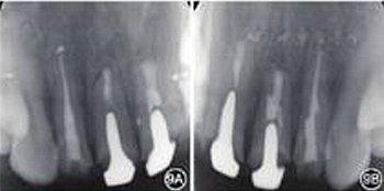 【病例討論】根管治療失敗患牙再治療一例(下) 【病例討論】根管治療失敗患牙再治療一例(下)