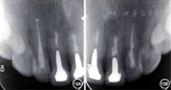 【病例討論】根管治療失敗患牙再治療一例(下) 【病例討論】根管治療失敗患牙再治療一例(下)