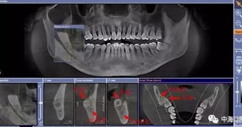 拔牙非小事，請不要拿成本衡量牙醫(yī)的價值！